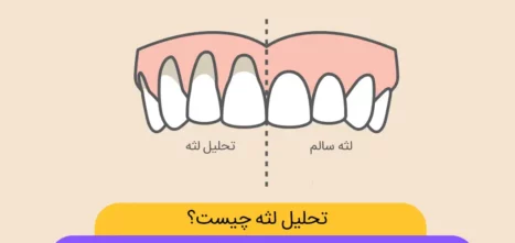 تحلیل لثه یا عقب نشینی لثه