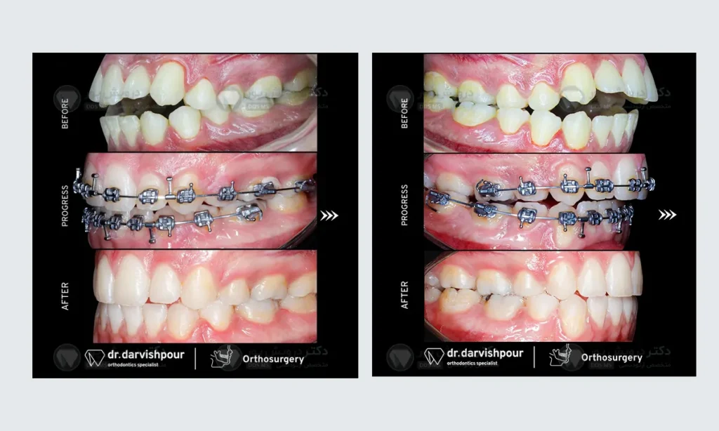 ارتودنسی نوجوانان به صورت ثابت