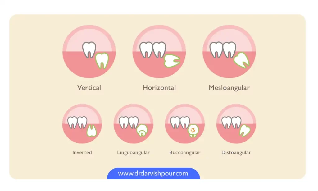 حالات مختلف دندان عقل نهفته