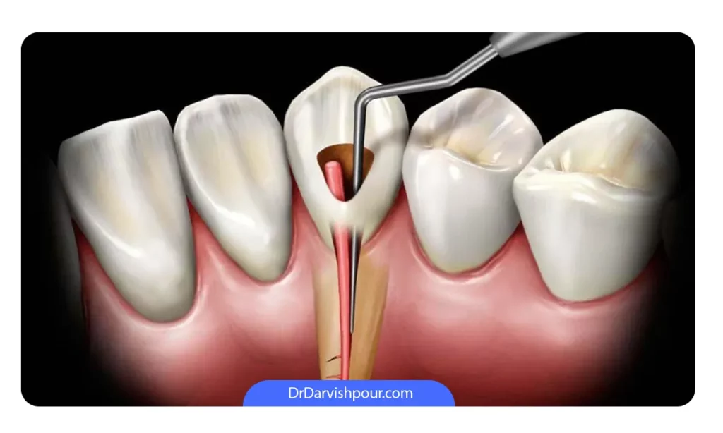 عصب کشی دندان برای کاهش درد عصب