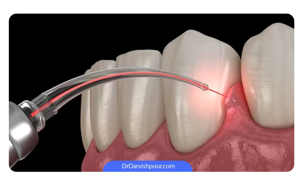 درمان خونریزی لثه با لیزر