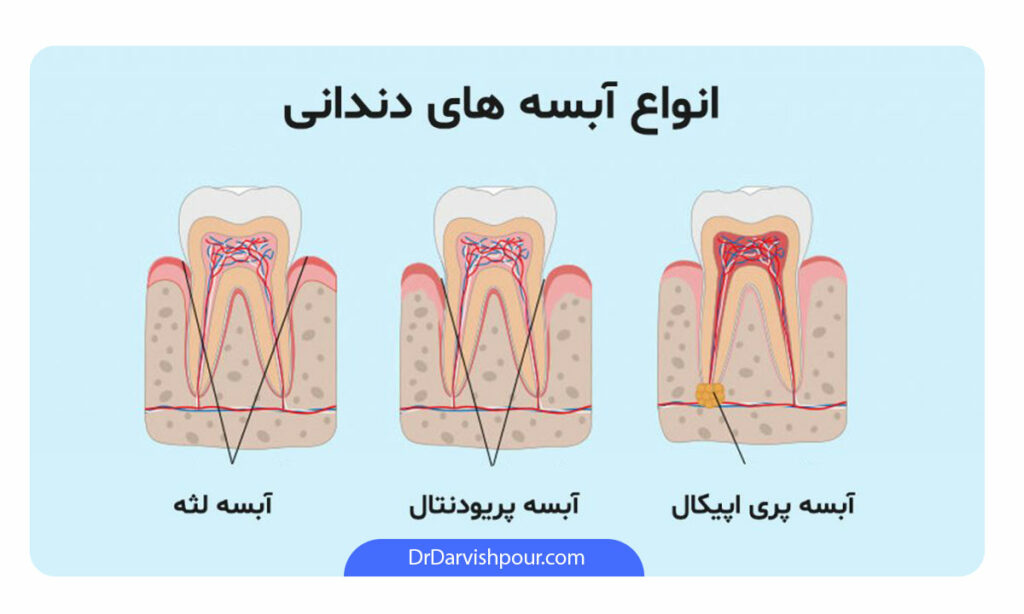 عکس انواع آبسه دندان