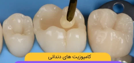 عکس کامپوزیت دندان