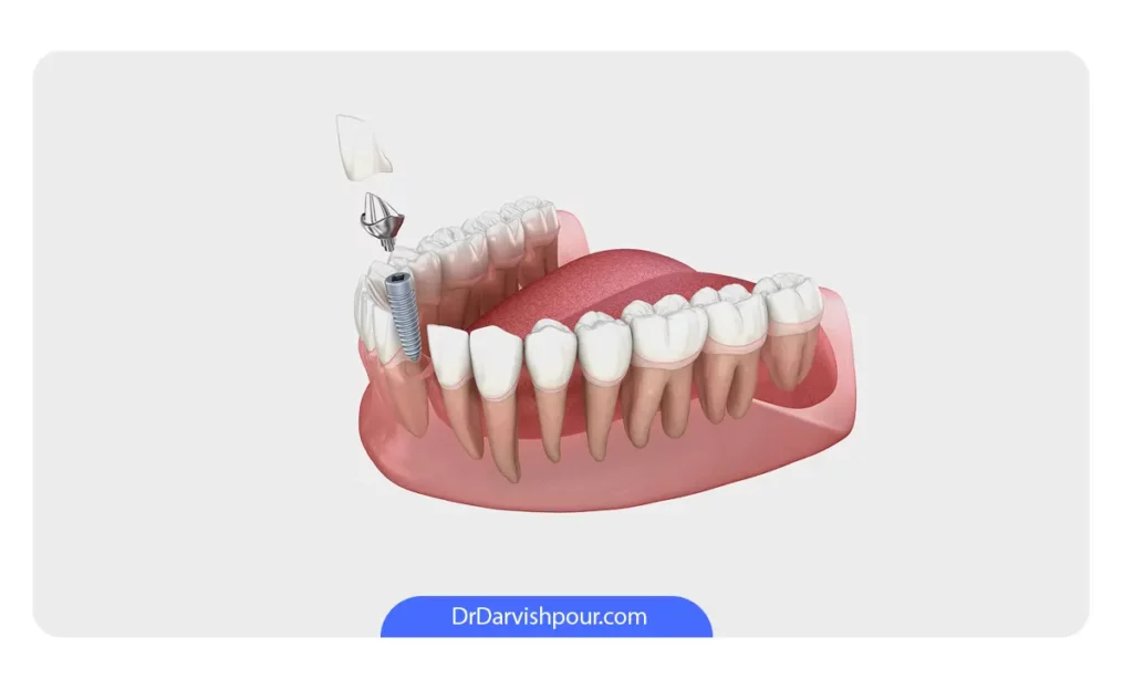 کاشت ایمپلنت دندان به جای فقط روکش کردن