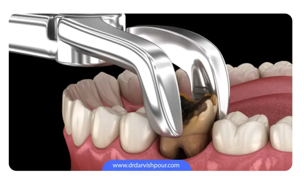 کشیدن دندان برای کاشت ایمپلنت فوری